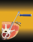 Minimally Invasive Spine Surgery
