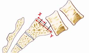 wu_spondylolisthesis_grade2